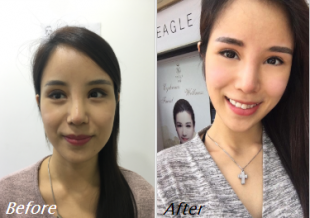 before after 4